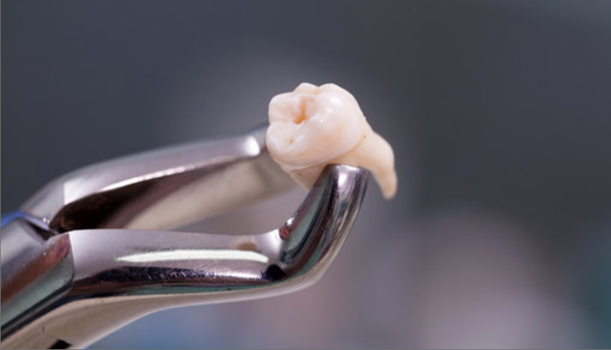 Tooth Extraction